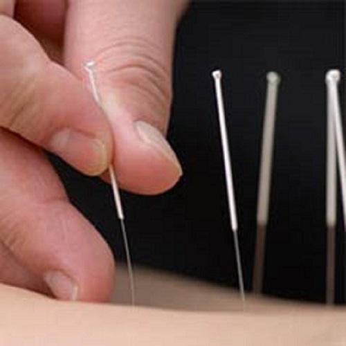 Dry Needling Caboolture